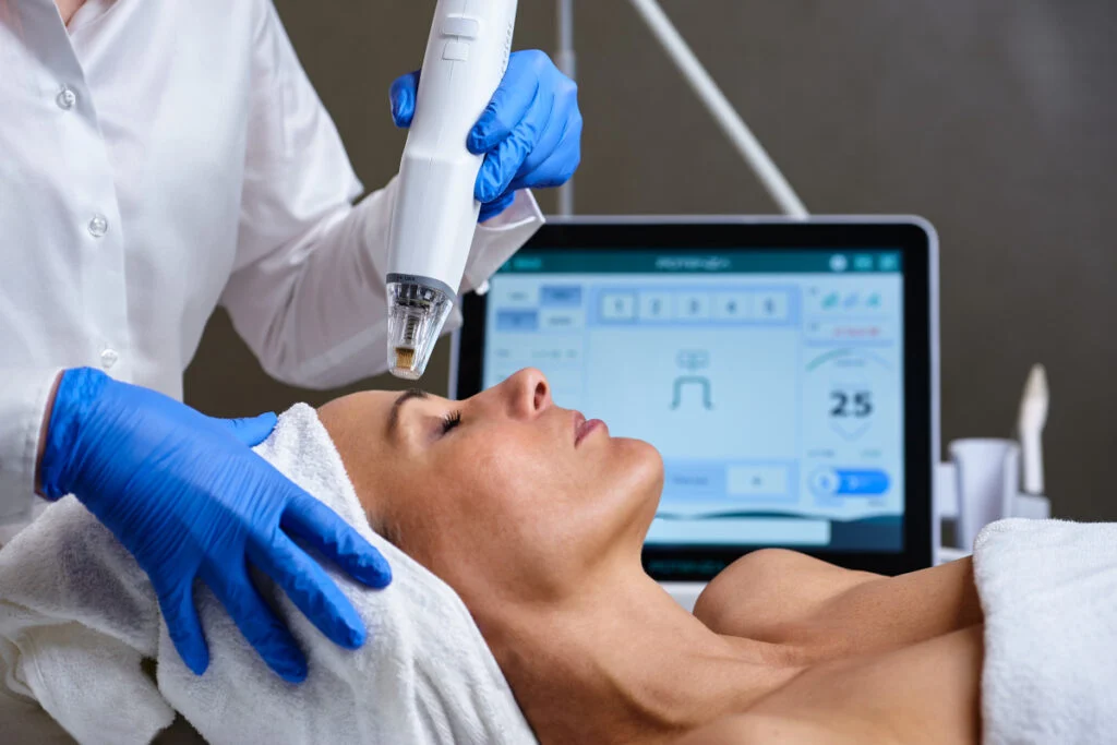 Radiofrequenz-Microneedling-Behandlung