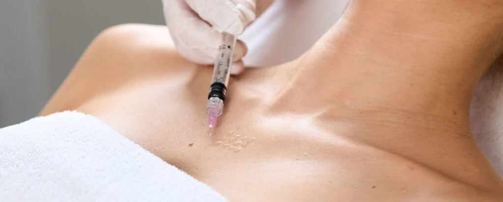Mesotherapie am Dekollete