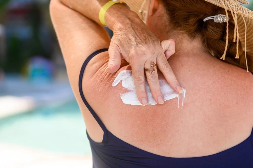 Frau, die Sonnencreme auf eine sonnenverbrannte Schulter in einem tropischen Resort aufträgt