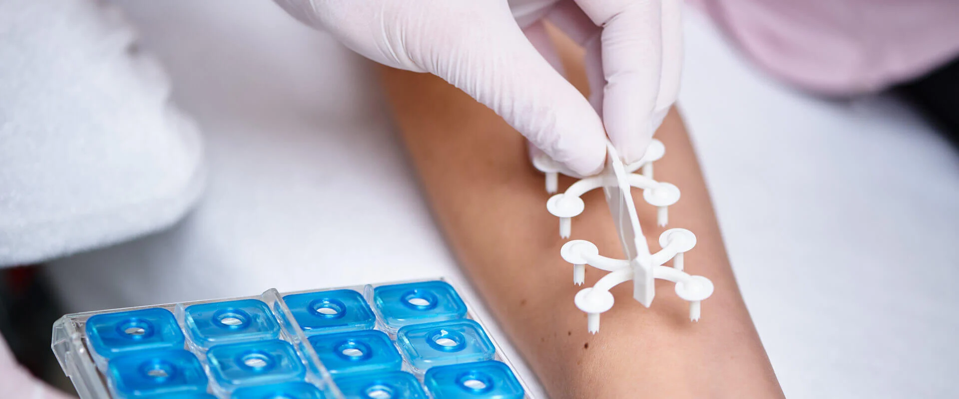 Allergietest am Unterarm
