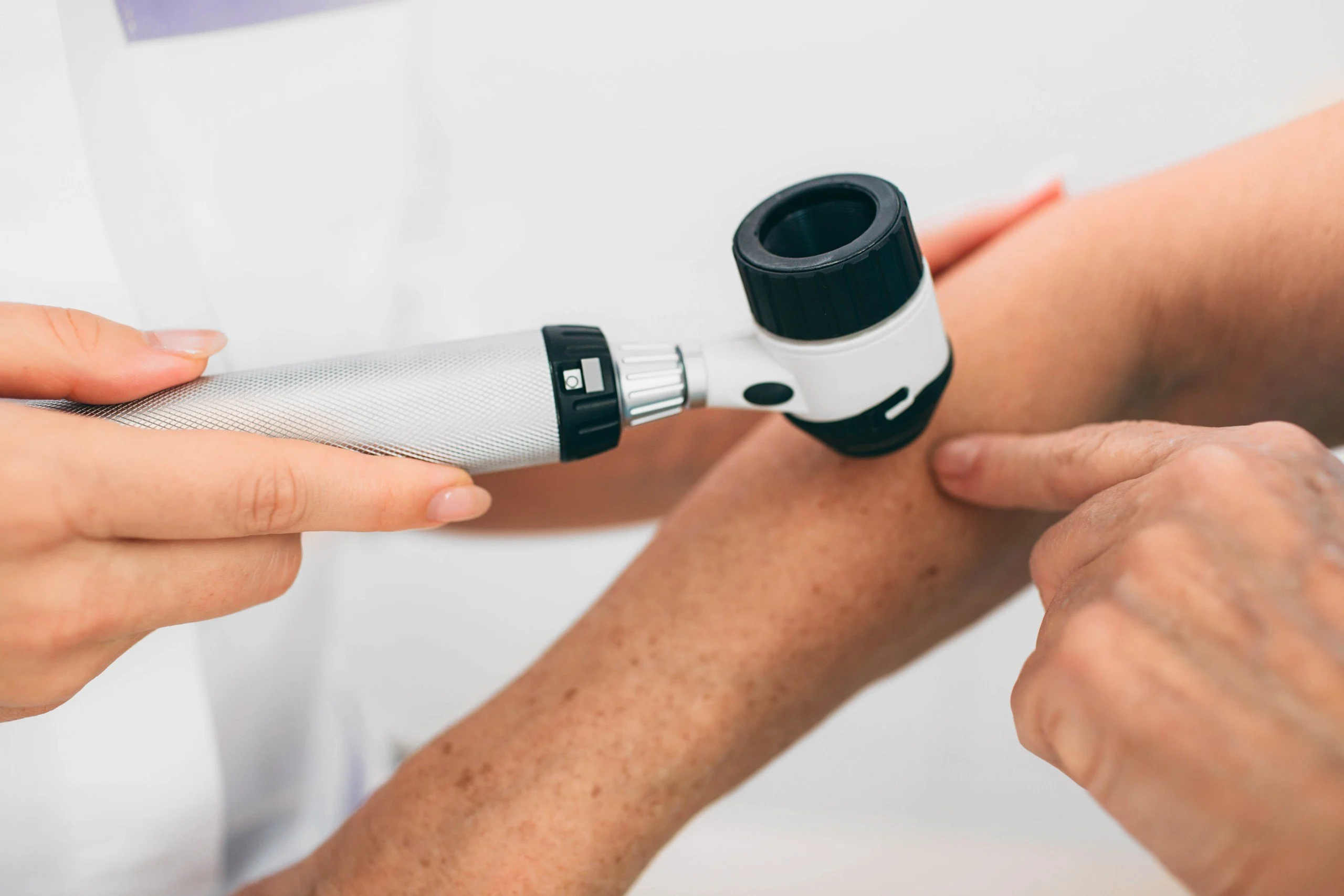 Doctor examining patient skin moles with dermoscope