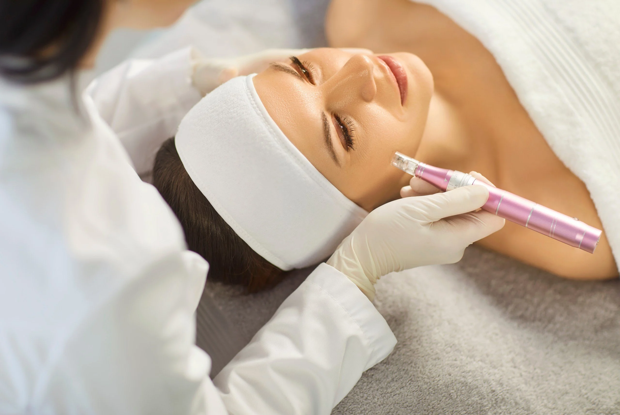 Microneedling mit einem Needling-Gerät im Gesicht einer entspannten Patientin