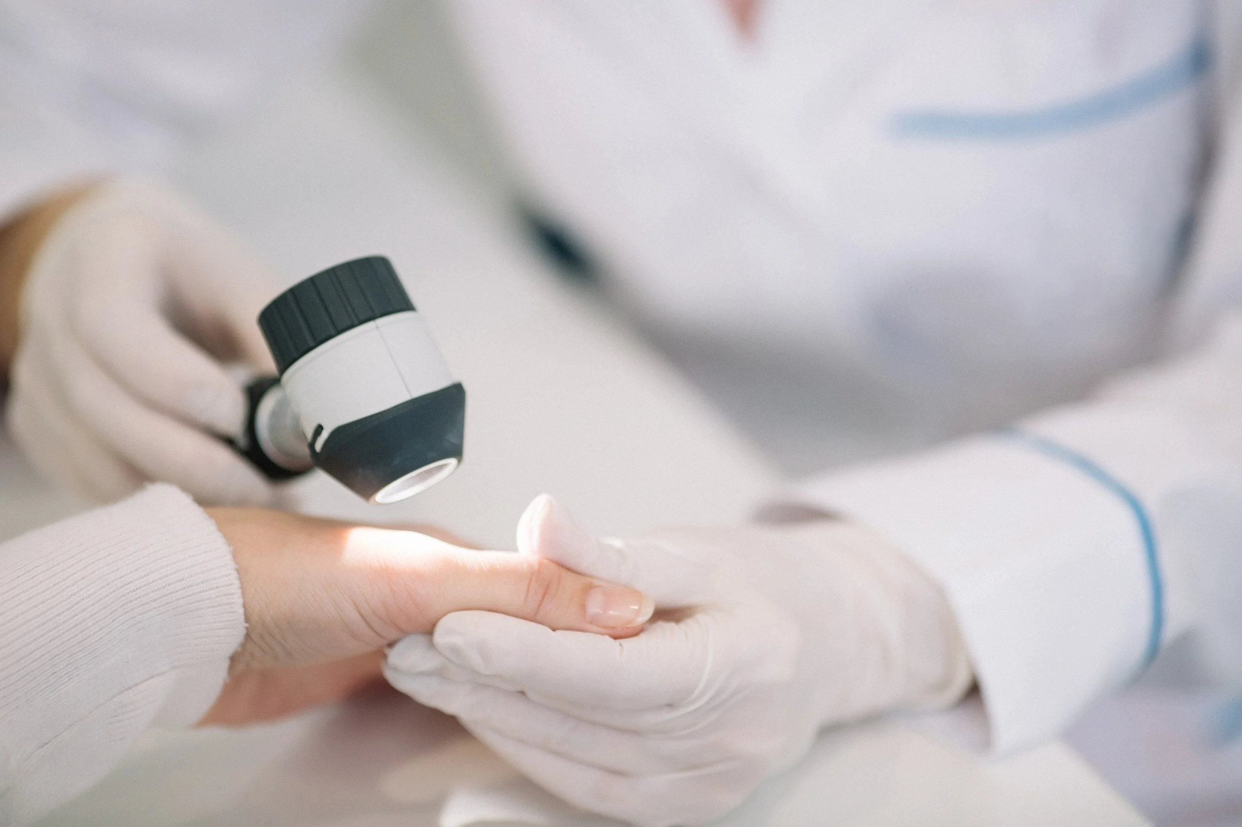 Nahaufnahme von Dermatologen untersuchen Maulwurf an Hand der Patientin in der Klinik